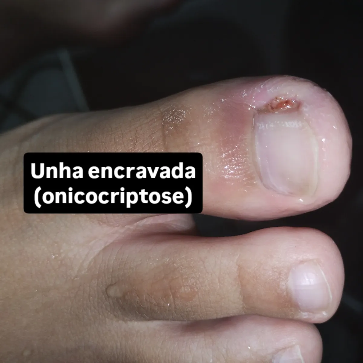 Trabalho de Podólogo(a) por Vera Rosa Podologa em Praia Grande — foto 3 de 17