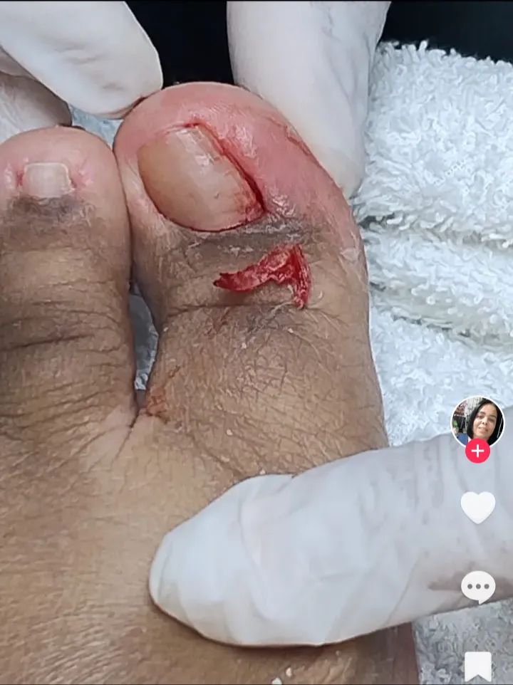 Trabalho de Podólogo(a) por Vera Rosa Podologa em Praia Grande — foto 7 de 17