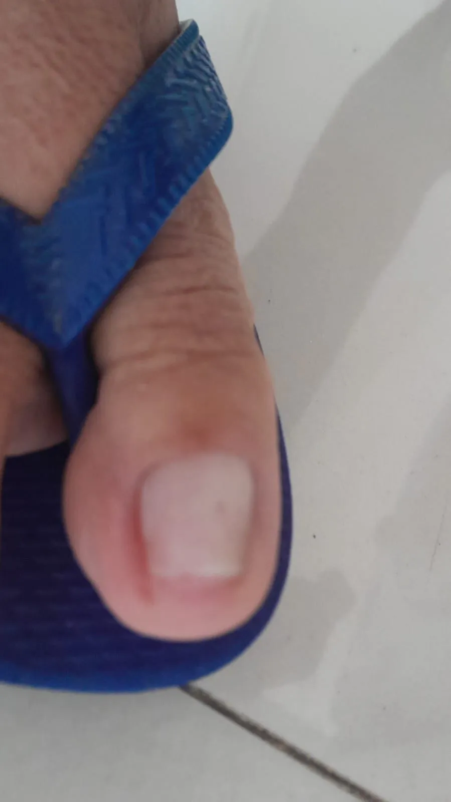 Trabalho de Podólogo(a) por Vera Rosa Podologa em Praia Grande — foto 9 de 17