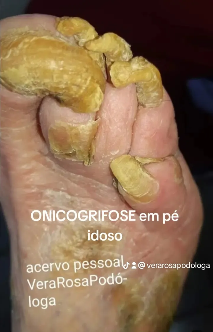 Trabalho de Podólogo(a) por Vera Rosa Podologa em Praia Grande — foto 12 de 17