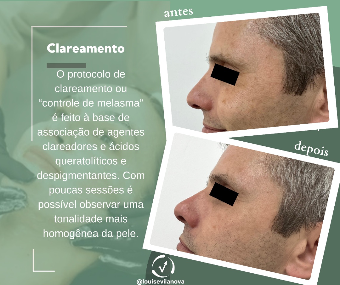 Trabalho de Esteticista por Louise Vilanova em Indianópolis, São Paulo — foto 2 de 15