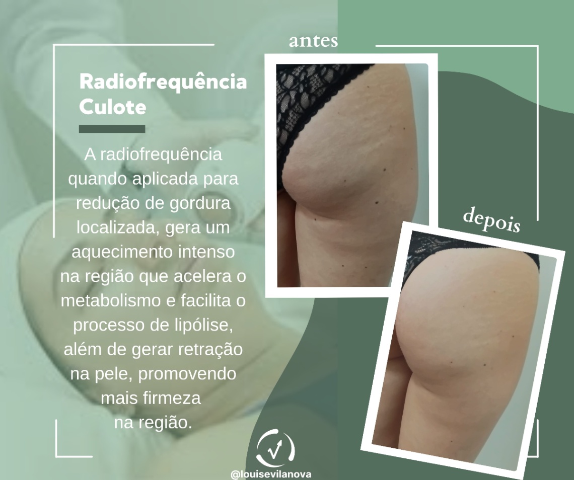 Trabalho de Esteticista por Louise Vilanova em Indianópolis, São Paulo — foto 10 de 15