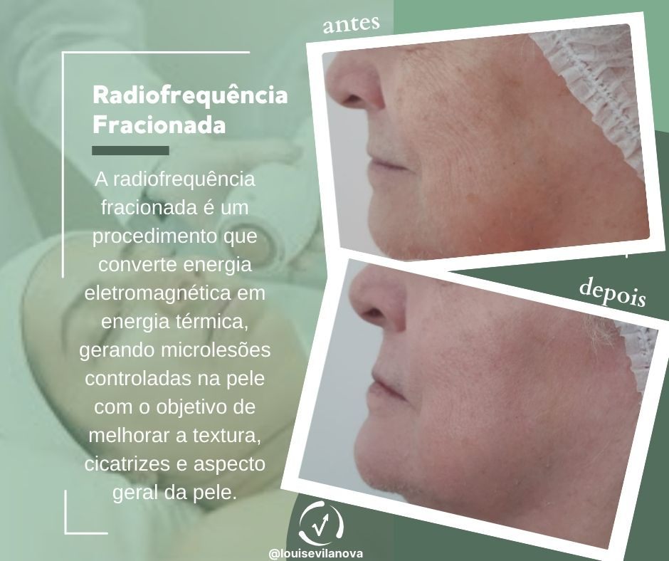 Trabalho de Esteticista por Louise Vilanova em Indianópolis, São Paulo — foto 14 de 15